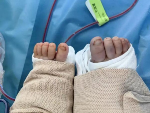 永崋证券 女婴小腿完全离断，“保腿”之战创年龄最小纪录